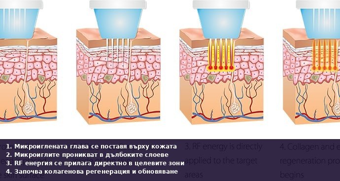 Gold RF Microneedling